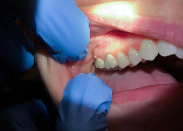 Best Dental Abscess Treatment in Fort Knox, KY